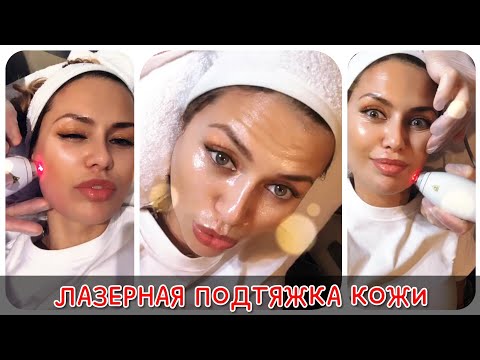 Видео: БОНЯ Виктория - Лазерная подтяжка кожи