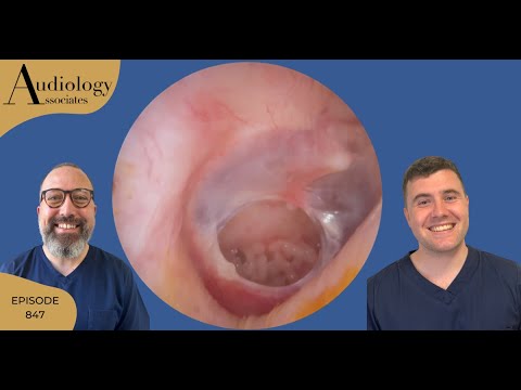 Видео: Перфорированная барабанная перепонка и глубокое удаление ушной серы - EP847