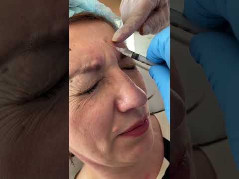 Видео: 👨‍🔬 Демонстрація курсу Ботулінотерапія FULL FACE. Відпрацювання на моделі (рос) 👨‍🔬
