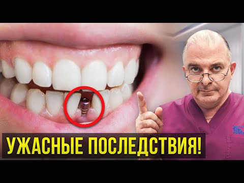 Видео: Самые ЧАСТЫЕ жалобы после ИМПЛАНТАЦИИ зубов! Важно знать!