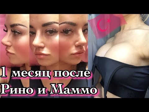 Видео: 1 МЕСЯЦ ПОСЛЕ! ПОВТОРНАЯ РИНО и МАММОПЛАСТИКА В ТУРЦИИ. БОЛЬ и ОТЕК