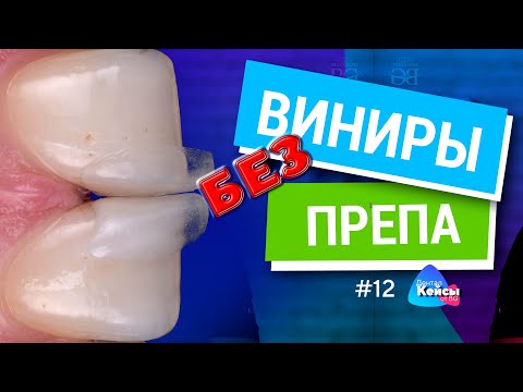 Видео: Виниры без препа. Дентал кейсы от BG #12