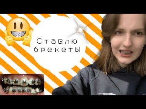 Видео: КАК МНЕ ПОСТАВИЛИ БРЕКЕТЫ И КАК Я К ЭТОМУ ПРИШЛА➣Kairas