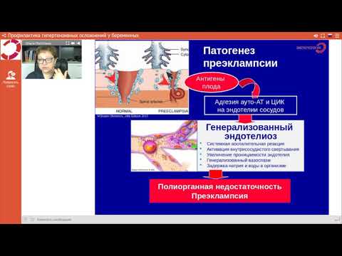 Видео: Экспертология | Преэклампсия Пустотина О.А.