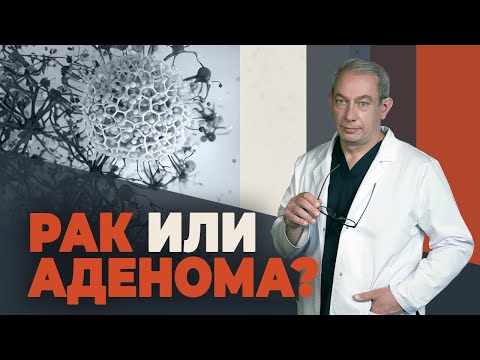 Видео: 4 признака, как отличить рак от аденомы простаты
