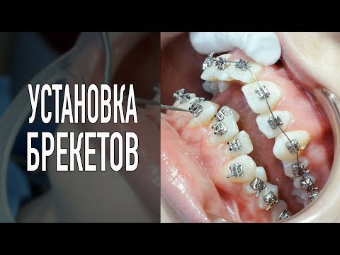 Видео: Установка брекетов – макро съемка только у нас! Брекеты Самара