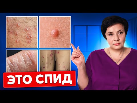 Видео: Не игнорируй! ЭТИ симптомы могут указывать на ВИЧ!