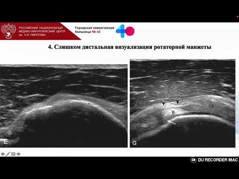 Видео: «Подводные камни» и ошибки при УЗ сканировании ротаторной манжеты в норме