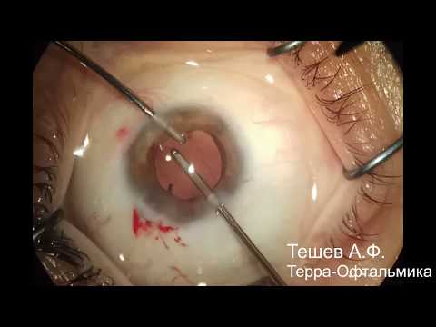 Видео: Факоэмульсификация осложненной катаракты с имплантацией ИОЛ