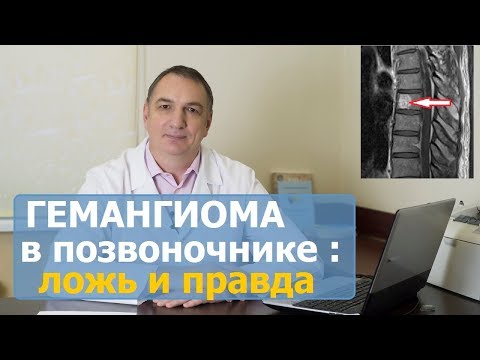 Видео: ГЕМАНГИОМА позвоночника: симптомы, КАК ЛЕЧИТЬ. Гемангиома тела ПОЗВОНКА: опасно ли, и что делать