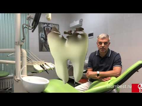 Видео: Имплантация и протезирование "Все-на-4" и "Все-на-6"
