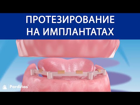 Видео: Протезирование на имплантатах ©