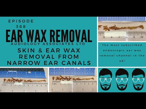 Видео: Удаление кожной ленты и ушной серы из узких ушных каналов - EP 368