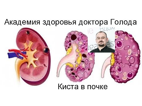 Видео: Киста в почке.