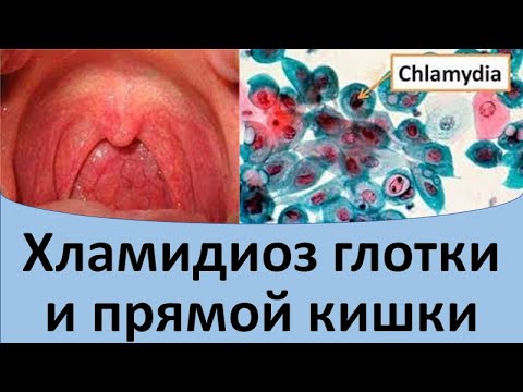 Видео: Хламидиоз глотки и прямой кишки