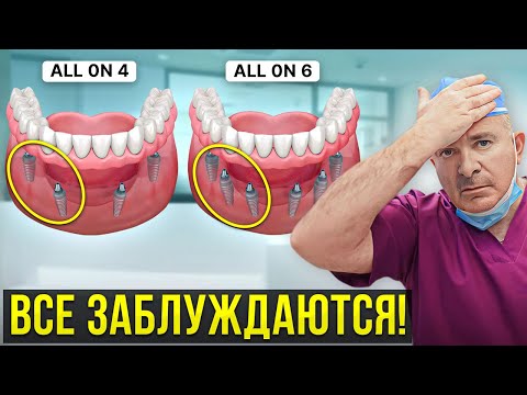 Видео: Вся правда об имплантации ВСЕ-НА-4 и ВСЕ-НА-6! Об этом молчат все стоматологи…