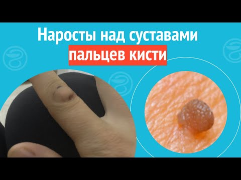Видео: 🤚 Наросты над суставами пальцев кисти. Клинический случай №1695