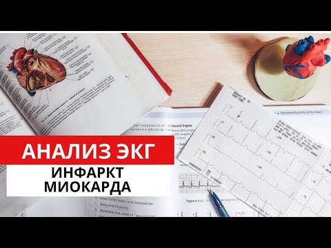 Видео: Инфаркт Миокарда. ЭКГ диагностика. Часть 1.