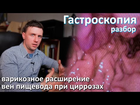 Видео: Варикозное расширение вен пищевода и желудка при циррозах печени. Разбор гастроскопии