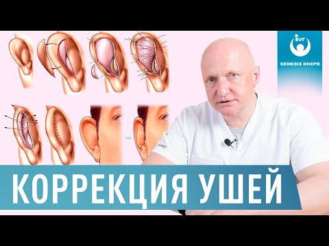Видео: Беспокоит лопоухость или оттопыренные уши? Лазерная коррекция ушей - отопластика | Хирург Щевцов