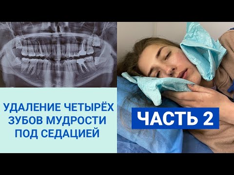 Видео: ЖАЛЕЮ, ЧТО УДАЛИЛИ 4 ЗУБА МУДРОСТИ ЗА РАЗ? | ПОСЛЕДСТВИЯ УДАЛЕНИЯ ЗУБОВ МУДРОСТИ