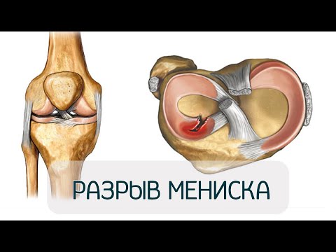 Видео: Травма, разрыв мениска. Оперировать или лечить?