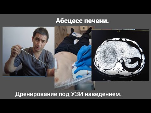 Видео: Абсцесс печени. Дренирование под УЗИ наведением.