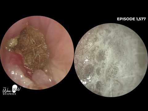 Видео: 1,577 — Мое самое сложное удаление ушной серы в 2024 году!