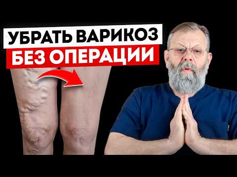 Видео: ✅ПОКАЗЫВАЮ КАК БЫСТРО ВЫЛЕЧИТЬ ВАРИКОЗ ЗА 7 МИНУТ
