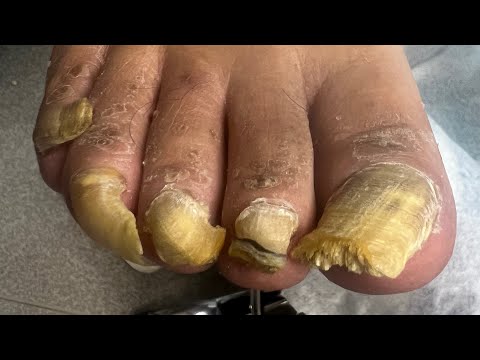 Видео: Онихогрифоз | Работа колпачком | работа аппаратом со спреем
