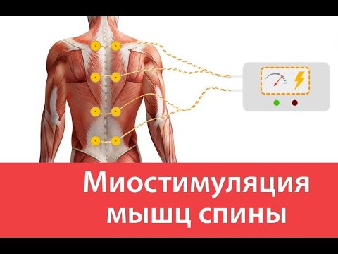 Видео: МИОСТИМУЛЯЦИЯ. Что это такое? Для чего? Как?