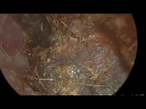 Видео: 1,621 - Удаление ушной серы, которое лишило меня дара речи!