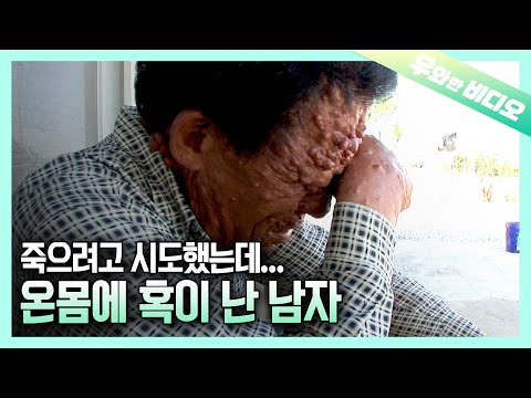 Видео: Мужчина, страдающий миомой, покрывающей его тело и лицо