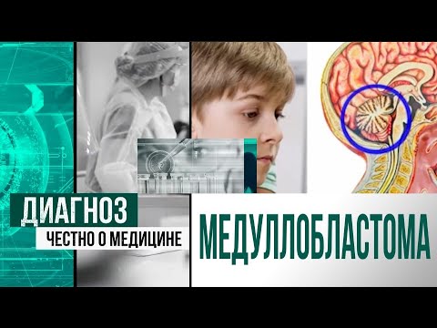 Видео: Медуллобластома: чем опасна опухоль головного мозга? | Диагноз