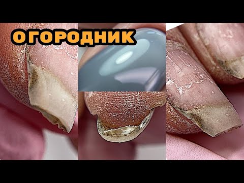 Видео: Ногти ОГОРОДНИКА 😮 Сколы у торца  / Коррекция ногтей гелем /Маникюр