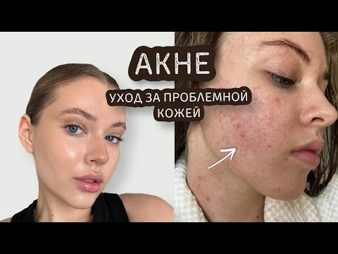 Видео: АКНЕ | уход за проблемной кожей