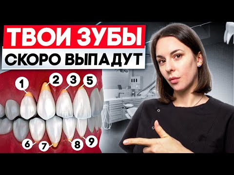 Видео: ОГОЛИЛИСЬ КОРНИ?! Как остановить рецессию десны? 5 факторов рецессии десны