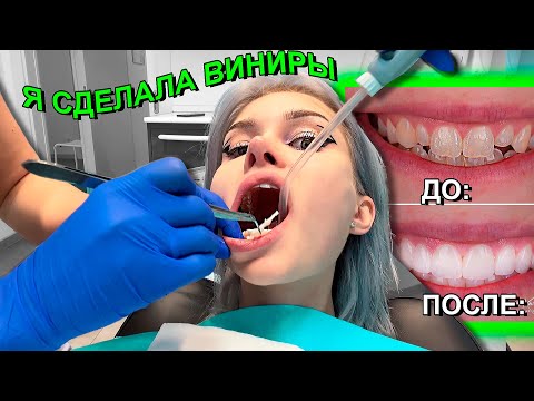 Видео: Я СДЕЛАЛА ВИНИРЫ 🦷 ДОРОГО И БОЛЬНО
