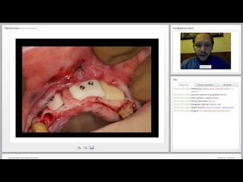 Видео: 2013 11 19 Аугментация костными блоками  0001