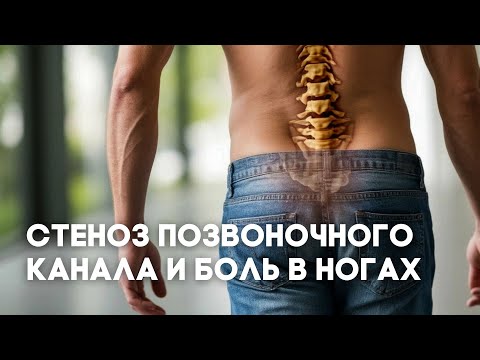 Видео: Стеноз позвоночного канала - почему его часто пропускают врачи?