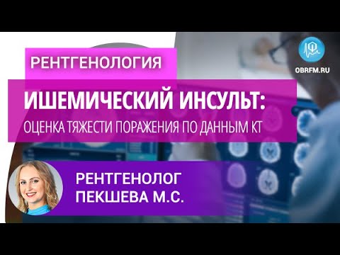 Видео: Врач-рентгенолог Пекшева М.С.: Ишемический инсульт: оценка тяжести поражения по данным КТ