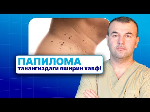 Видео: Папилома — хавфли касалликми? Сабаблари ва даволаш усуллари |  90 788 83 13