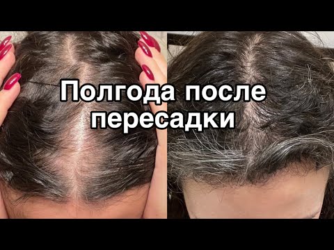 Видео: Полгода после пересадки волос