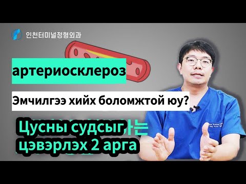 Видео: "Артериосклероз" -ийг эмнэлэгт эмчлэх боломжтой юу?