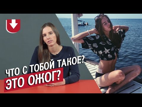 Видео: Люди с витилиго (белыми пятнами по всему телу) | Неудобные вопросы