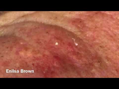 Видео: Солнечные комедоны у мотоциклиста, часть 3