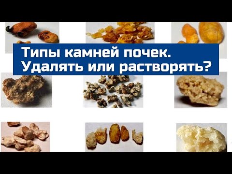 Видео: Что обязательно нужно узнать перед растворением камней почек