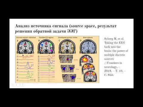 Видео: Критерии интериктальных эпилептиформных разрядов на ЭЭГ. Журнальный клуб АКСЛИН&Yes Russian Chapter