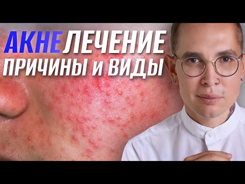 Видео: ЛЕЧЕНИЕ АКНЕ причины и виды #акне