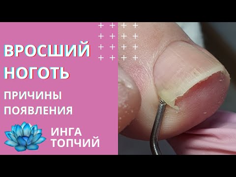 Видео: Вросший ноготь на ноге. Подногтевая мозоль удаление.
